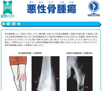 悪性骨腫瘍