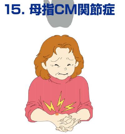 母子CM関節症